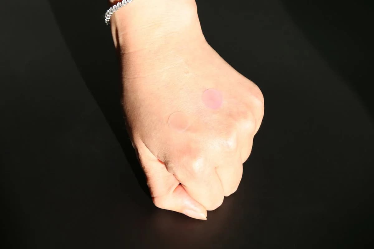 UV-Sensitive Acne Patch - 26