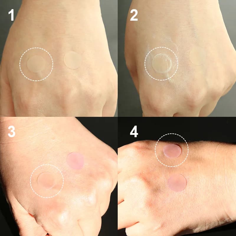 UV-Sensitive Acne Patch