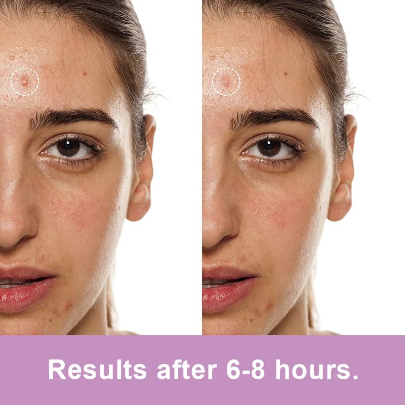 UV-Sensitive Acne Patch - 4
