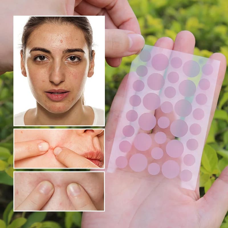 UV-Sensitive Acne Patch - 5