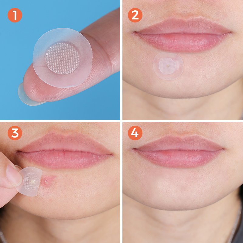 Microneedle Acne Patch (4+9 Pack) - 9