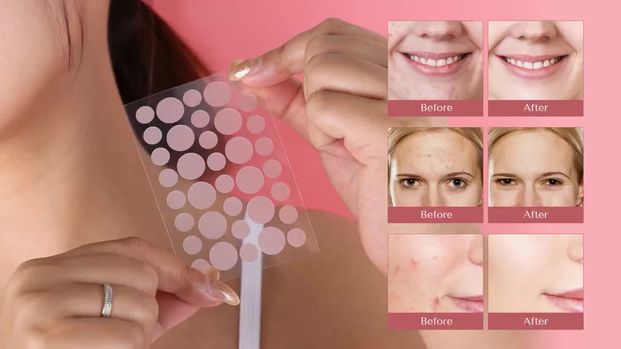 Acne Patch — Product Film